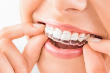 5 Reasons To Consider Clear Aligners For Your Teeth