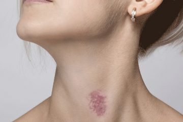 How to Get Rid of Hickies In Easy Steps!